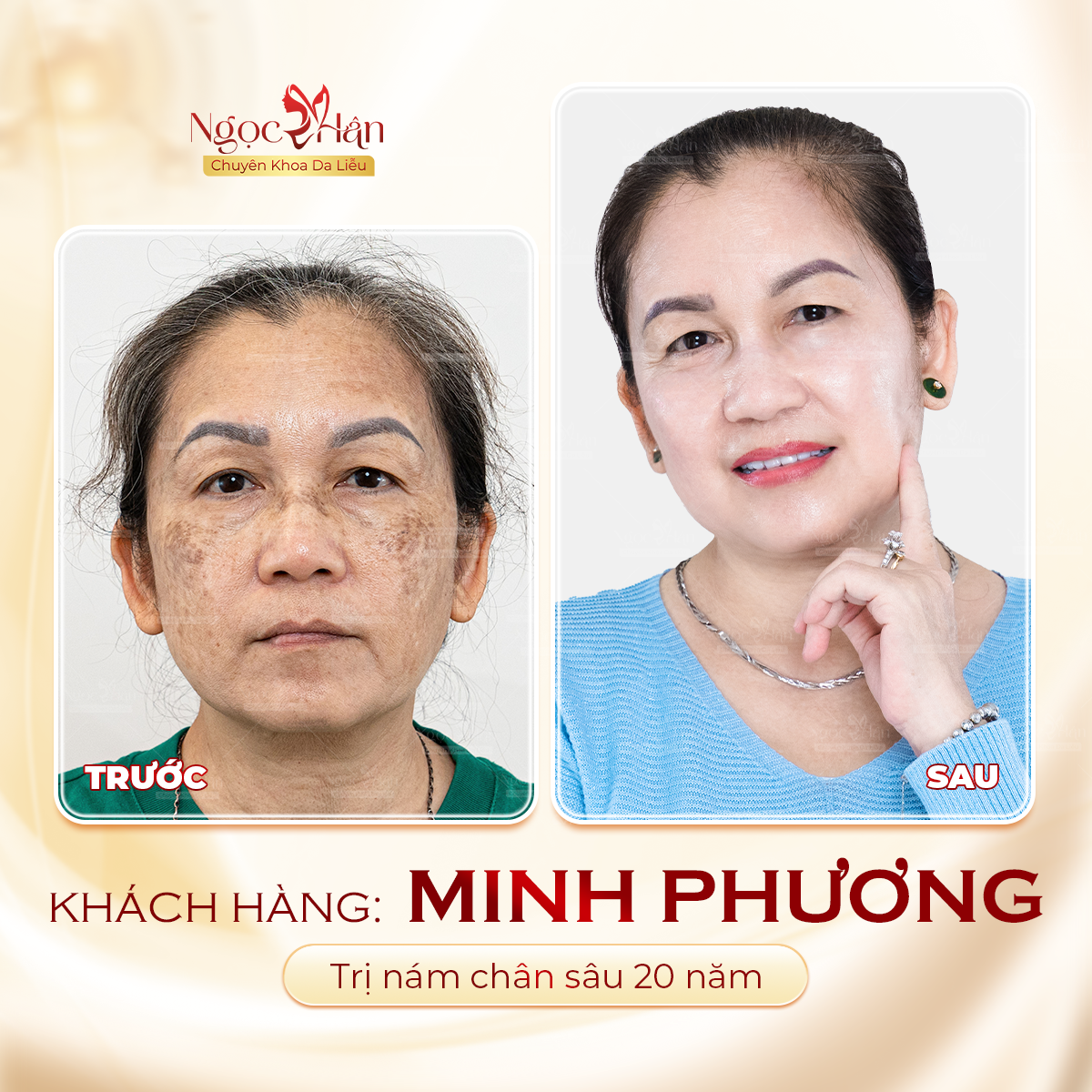 5 CÂU HỎI THƯỜNG GẶP VỀ TRỊ NÁM CHÂN SÂU? CÁCH ĐIỀU TRỊ HIỆU QUẢ