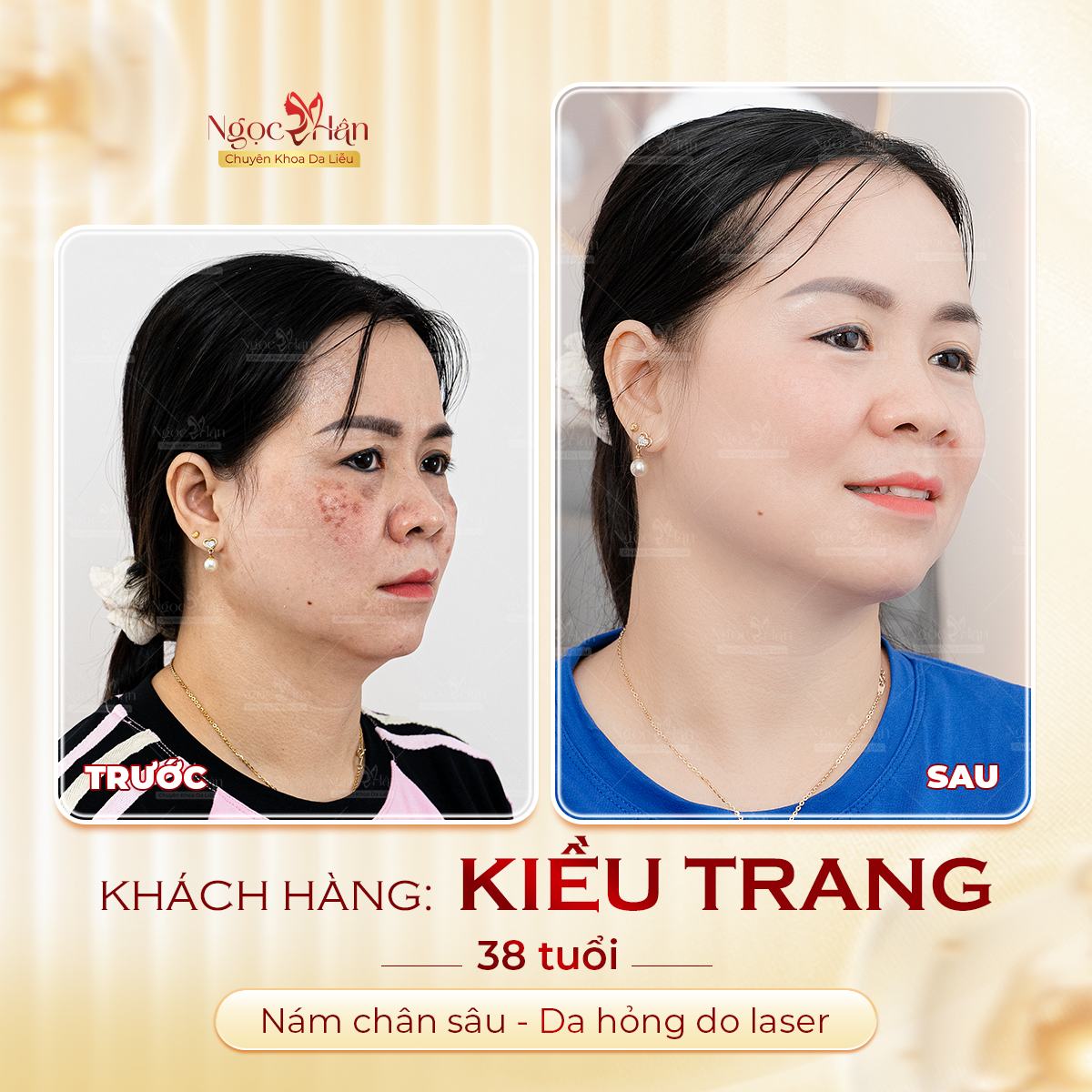 5 CÂU HỎI THƯỜNG GẶP VỀ TRỊ NÁM CHÂN SÂU? CÁCH ĐIỀU TRỊ HIỆU QUẢ