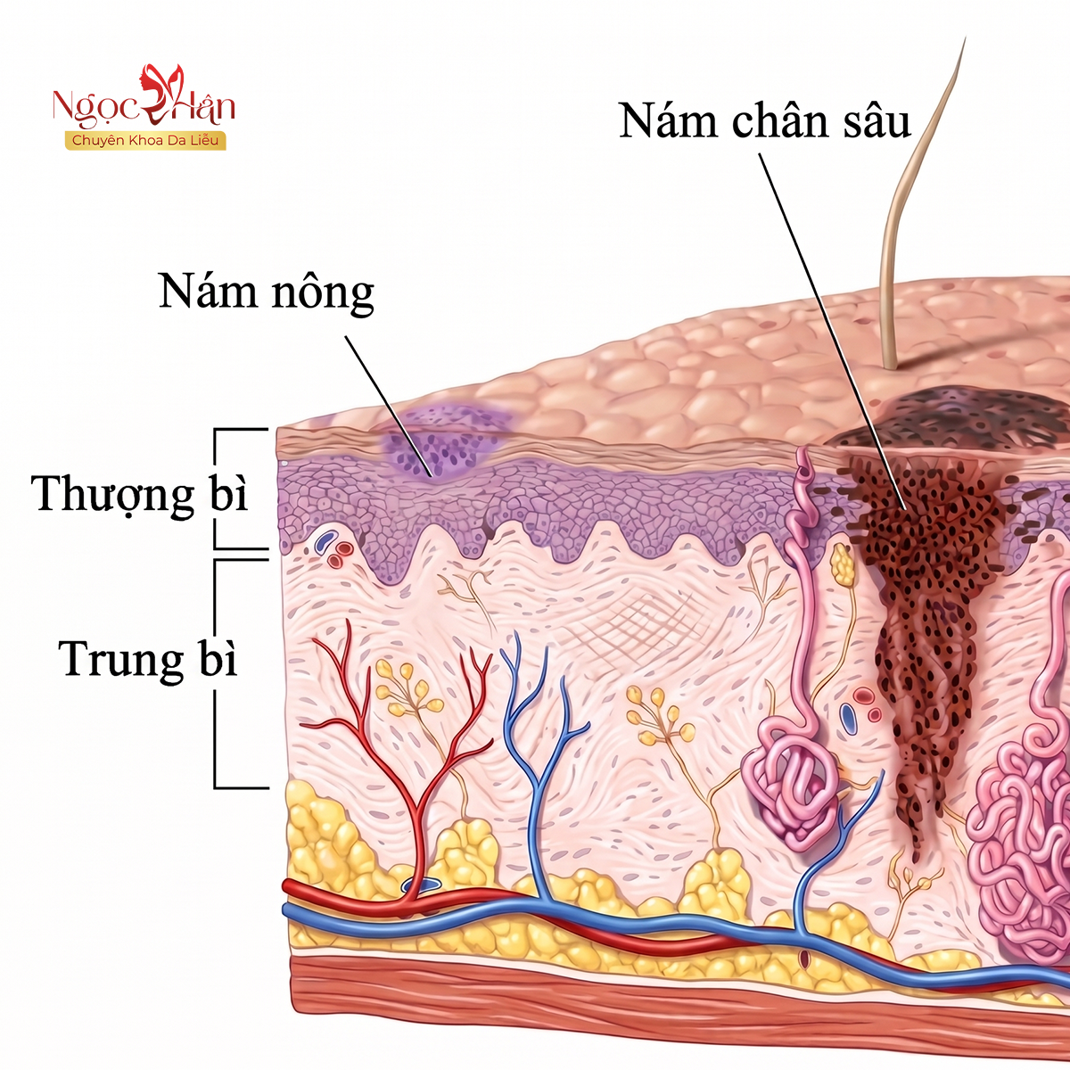 5 CÂU HỎI THƯỜNG GẶP VỀ TRỊ NÁM CHÂN SÂU? CÁCH ĐIỀU TRỊ HIỆU QUẢ