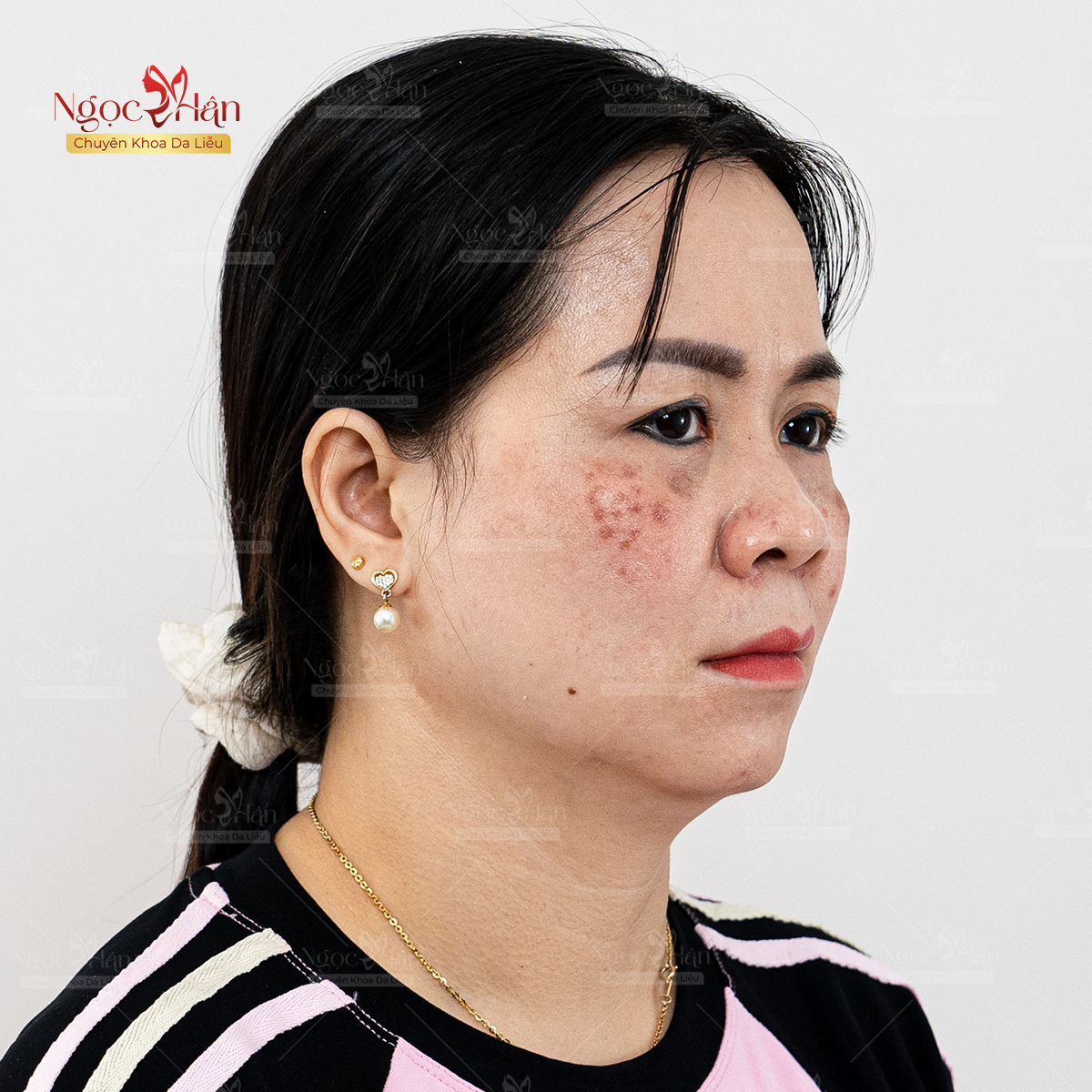 5 CÂU HỎI THƯỜNG GẶP VỀ TRỊ NÁM CHÂN SÂU? CÁCH ĐIỀU TRỊ HIỆU QUẢ