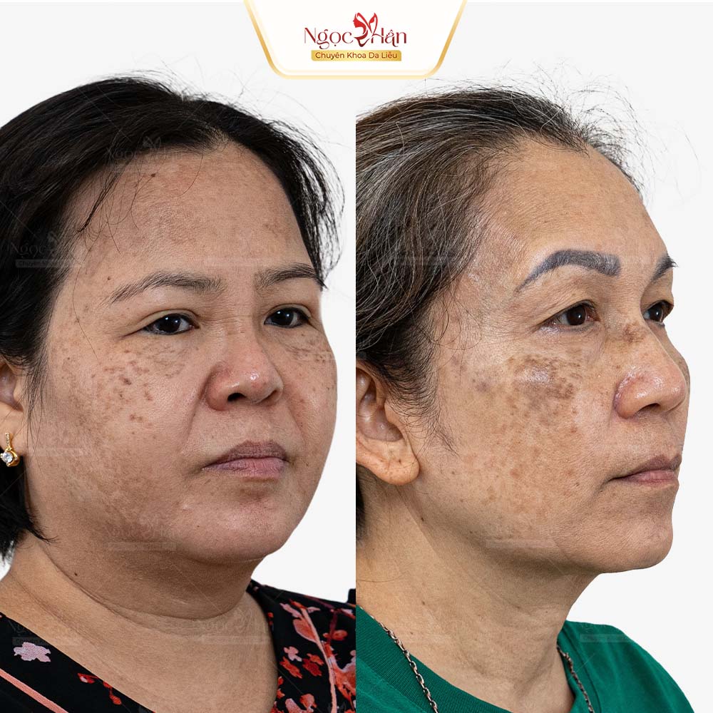 TRỊ NÁM NHIỀU NƠI KHÔNG HẾT: VÌ SAO NÁM VẪN TÁI PHÁT?