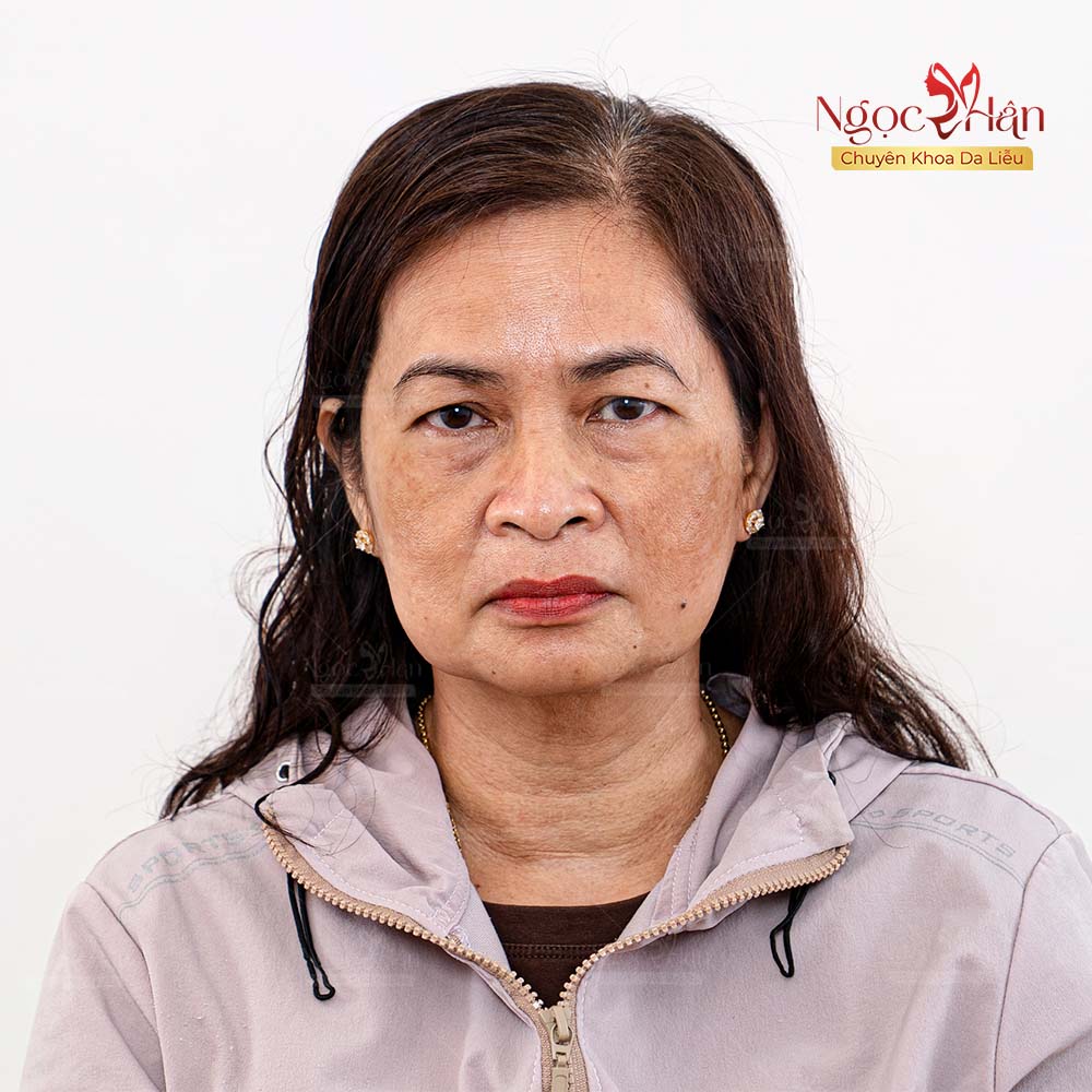 NÁM CÓ THỂ MỜ NHANH, NHƯNG KIỂM SOÁT NÁM LÂU DÀI MỚI LÀ ĐIỀU QUAN TRỌNG