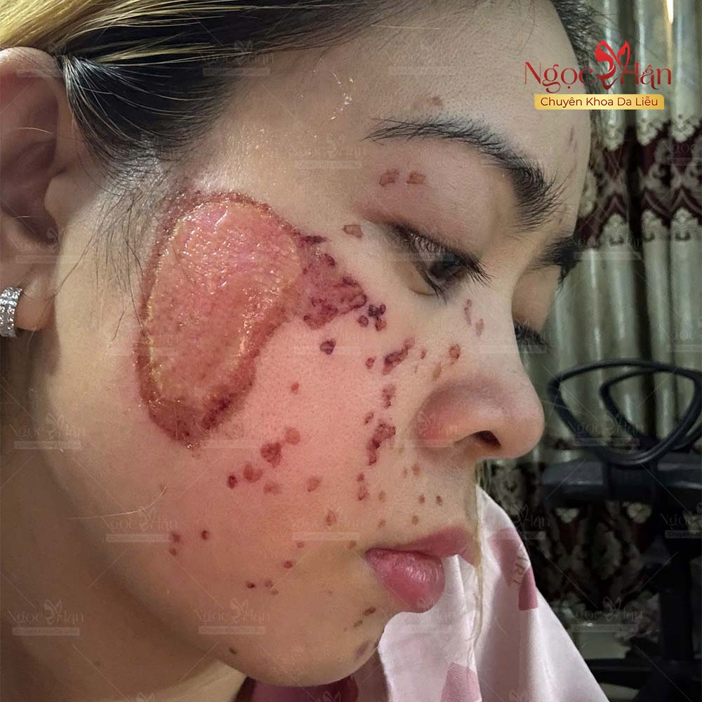NÁM CÓ THỂ MỜ NHANH, NHƯNG KIỂM SOÁT NÁM LÂU DÀI MỚI LÀ ĐIỀU QUAN TRỌNG