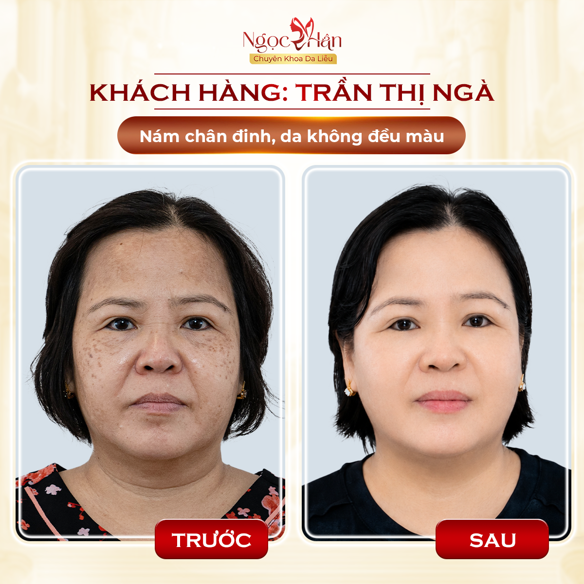 ĐIỀU TRỊ NÁM TẬN GỐC CẦN BAO NHIÊU BUỔI? ĐỊA CHỈ TRỊ NÁM UY TÍN TPHCM