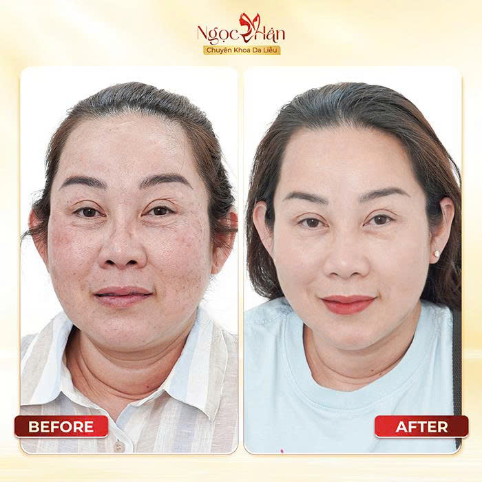 Phòng Khám Da Liễu Ngọc Hân – Chuyên Điều Trị Nám Da