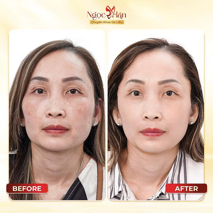 Phòng Khám Da Liễu Ngọc Hân – Chuyên Điều Trị Nám Da