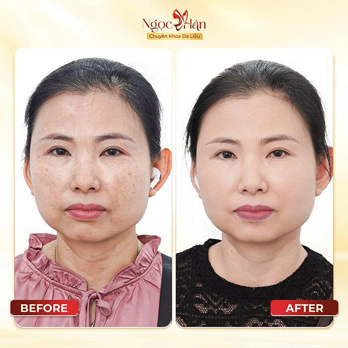 Phòng Khám Da Liễu Ngọc Hân – Chuyên Điều Trị Nám Da