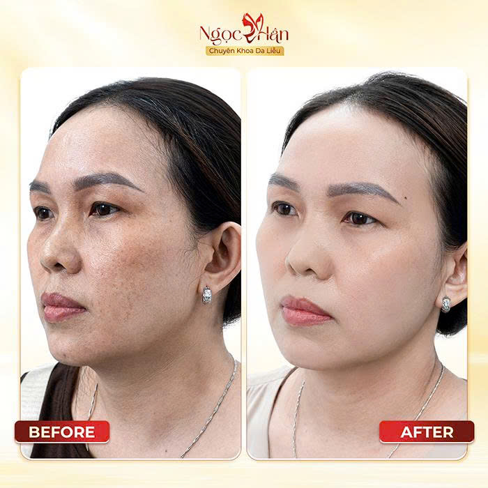 Phòng Khám Da Liễu Ngọc Hân – Chuyên Điều Trị Nám Da