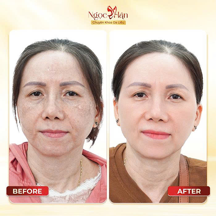 Phòng Khám Da Liễu Ngọc Hân – Chuyên Điều Trị Nám Da