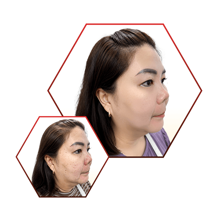 Phòng Khám Da Liễu Ngọc Hân – Chuyên Điều Trị Nám Da