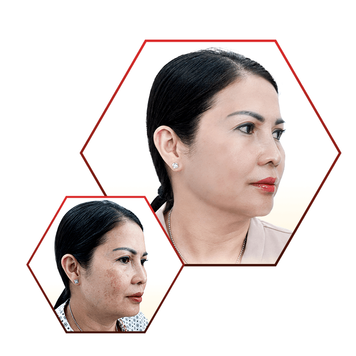 Phòng Khám Da Liễu Ngọc Hân – Chuyên Điều Trị Nám Da