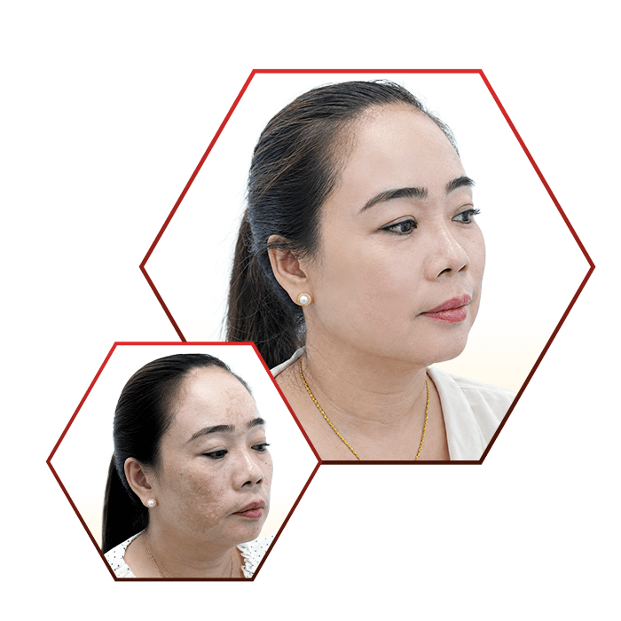 Phòng Khám Da Liễu Ngọc Hân – Chuyên Điều Trị Nám Da