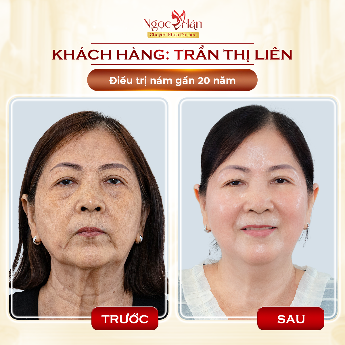 TRỊ NÁM LÂU NĂM CÓ KHÓ KHÔNG? TRỊ NÁM Ở ĐÂU TỐT NHẤT HIỆN NAY