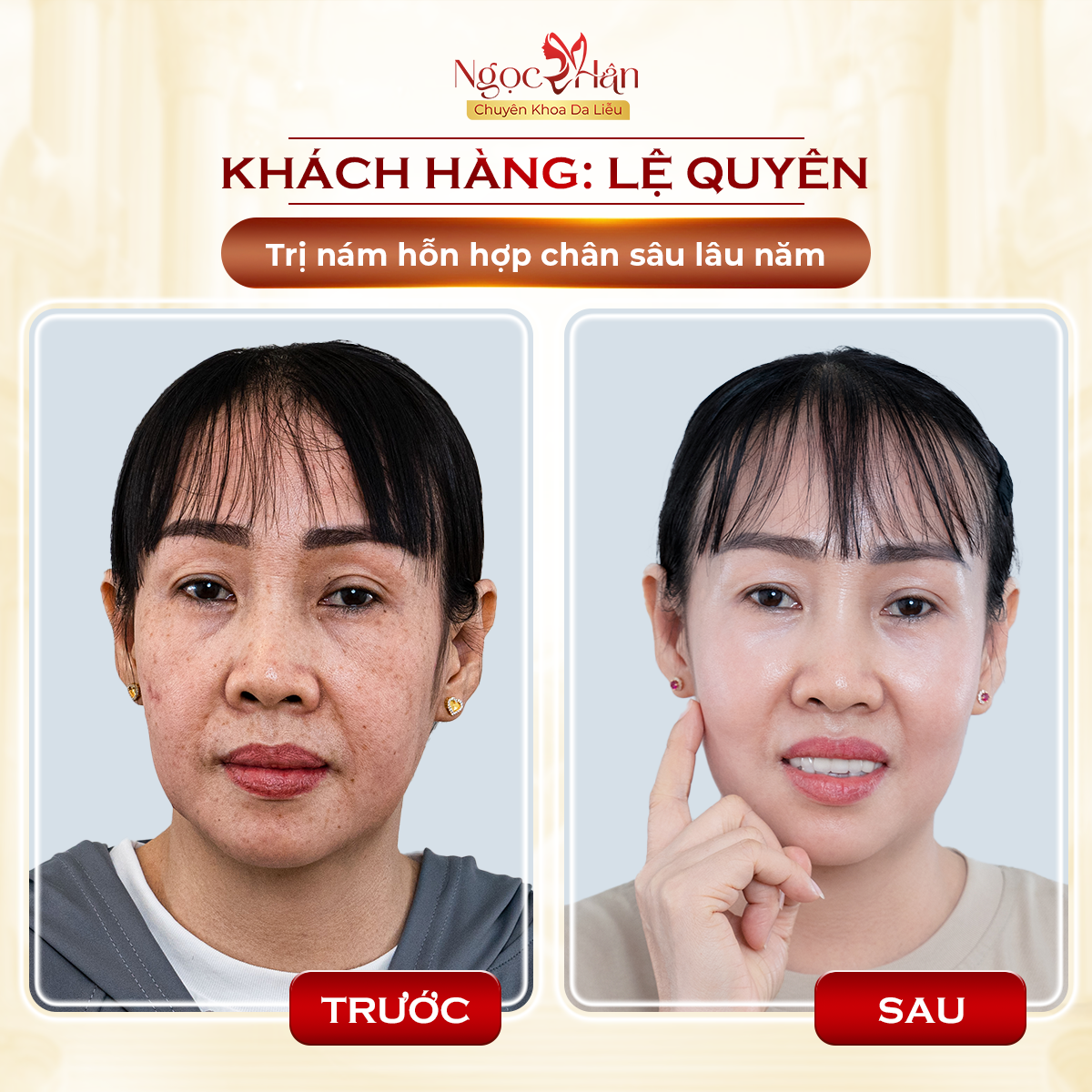 TRỊ NÁM LÂU NĂM CÓ KHÓ KHÔNG? TRỊ NÁM Ở ĐÂU TỐT NHẤT HIỆN NAY