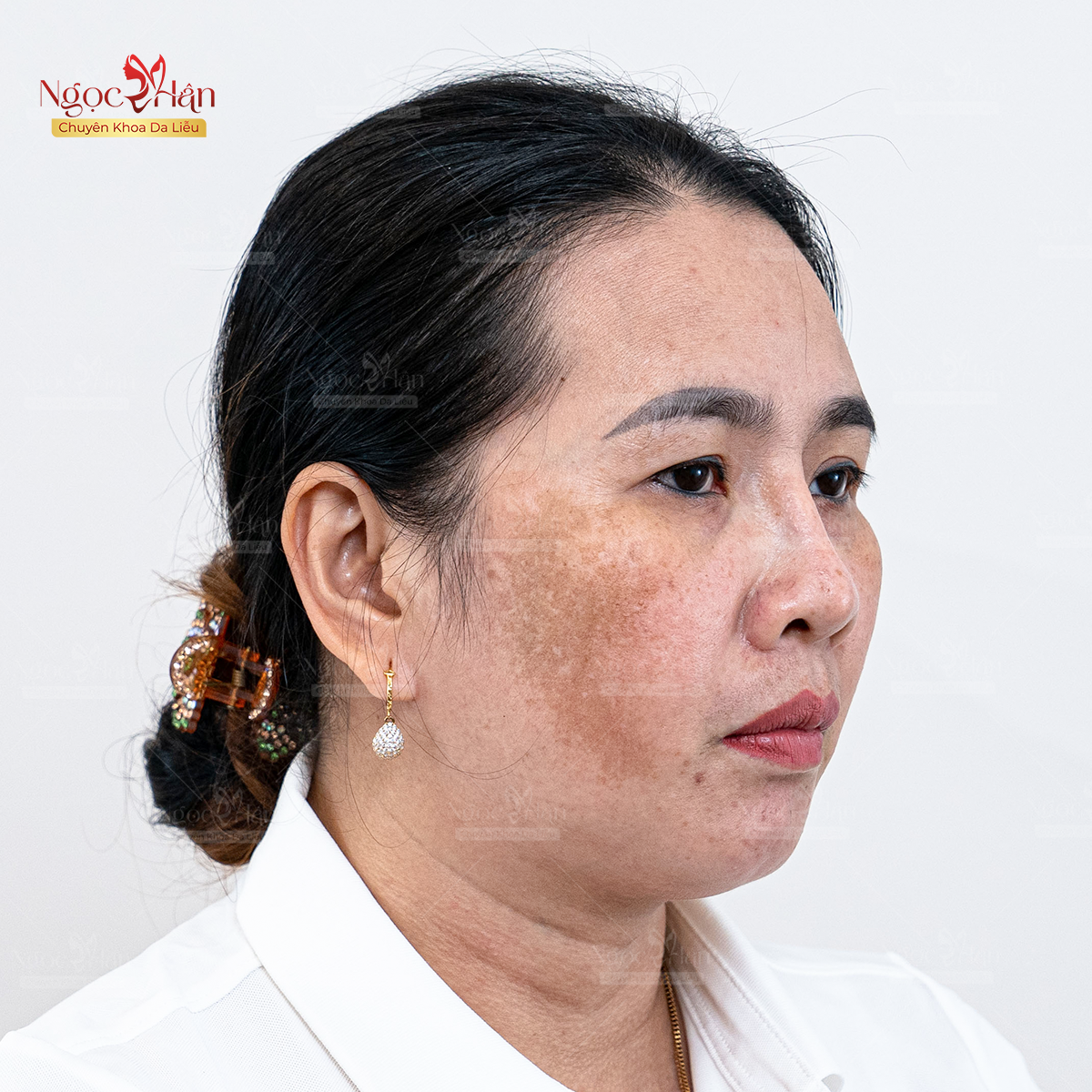 TRỊ NÁM LÂU NĂM CÓ KHÓ KHÔNG? TRỊ NÁM Ở ĐÂU TỐT NHẤT HIỆN NAY