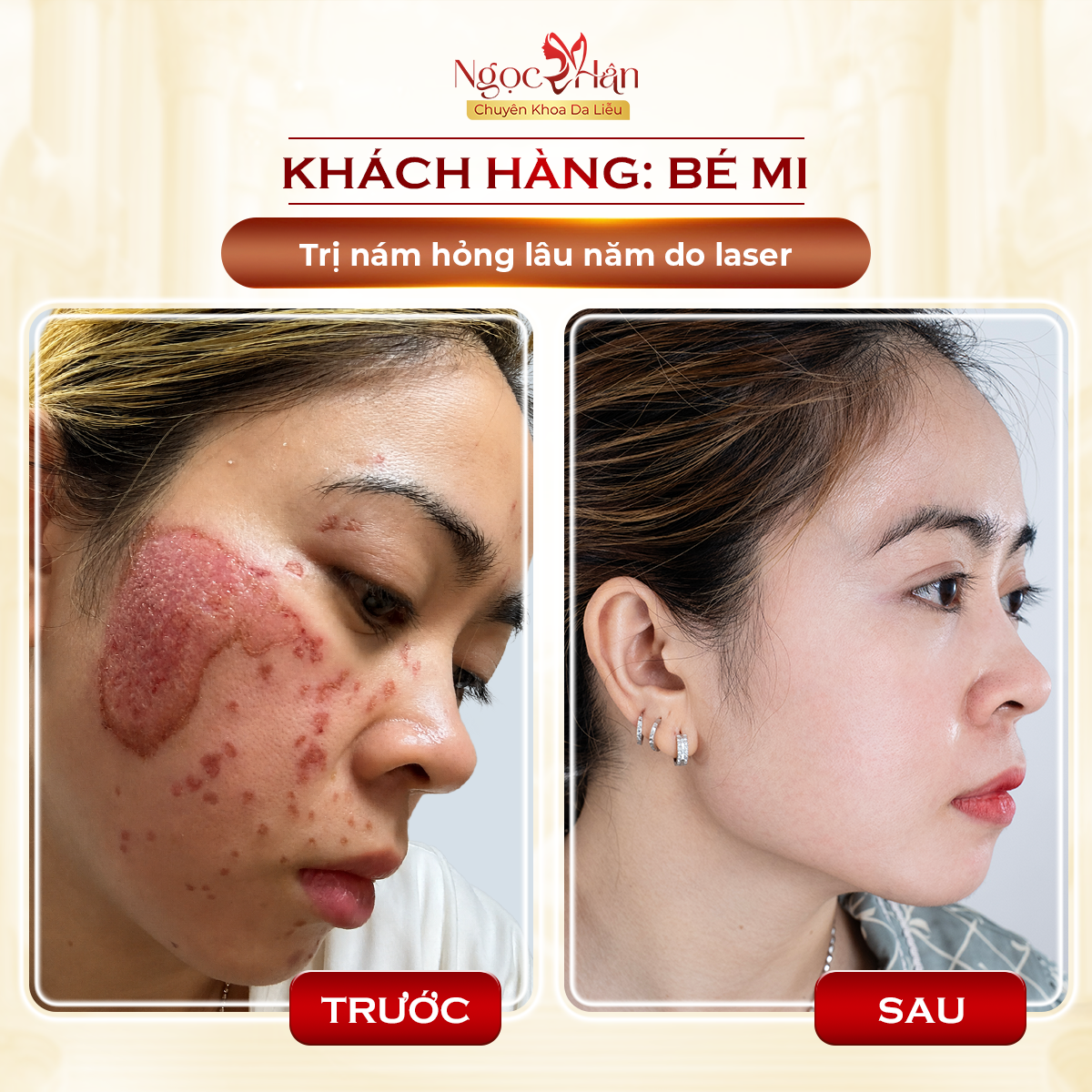 ĐIỀU TRỊ NÁM TẬN GỐC CẦN BAO NHIÊU BUỔI? ĐỊA CHỈ TRỊ NÁM UY TÍN TPHCM