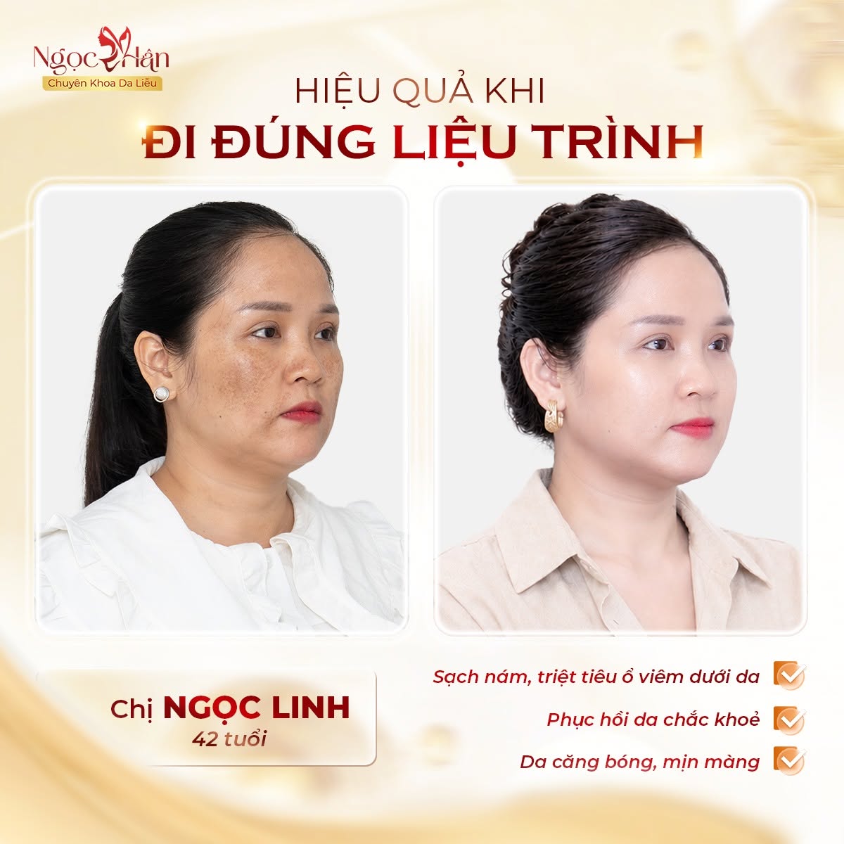 NÁM NỘI TIẾT LÀ GÌ? VÌ SAO CÀNG LỚN TUỔI CÀNG DỄ GẶP?