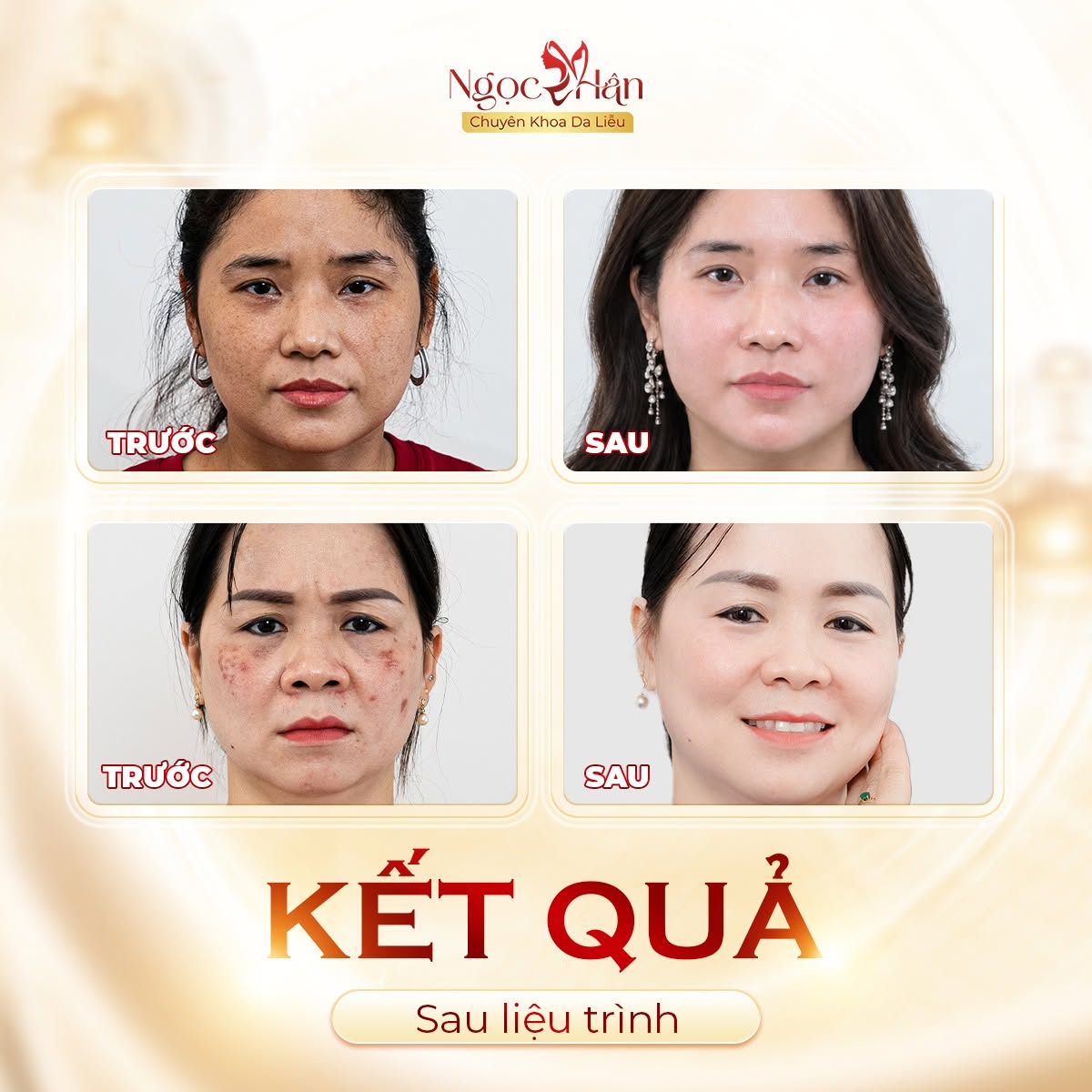 NÁM SAU SINH: NGUYÊN NHÂN, CÁCH ĐIỀU TRỊ NÁM DA SAU SINH HIỆU QUẢ