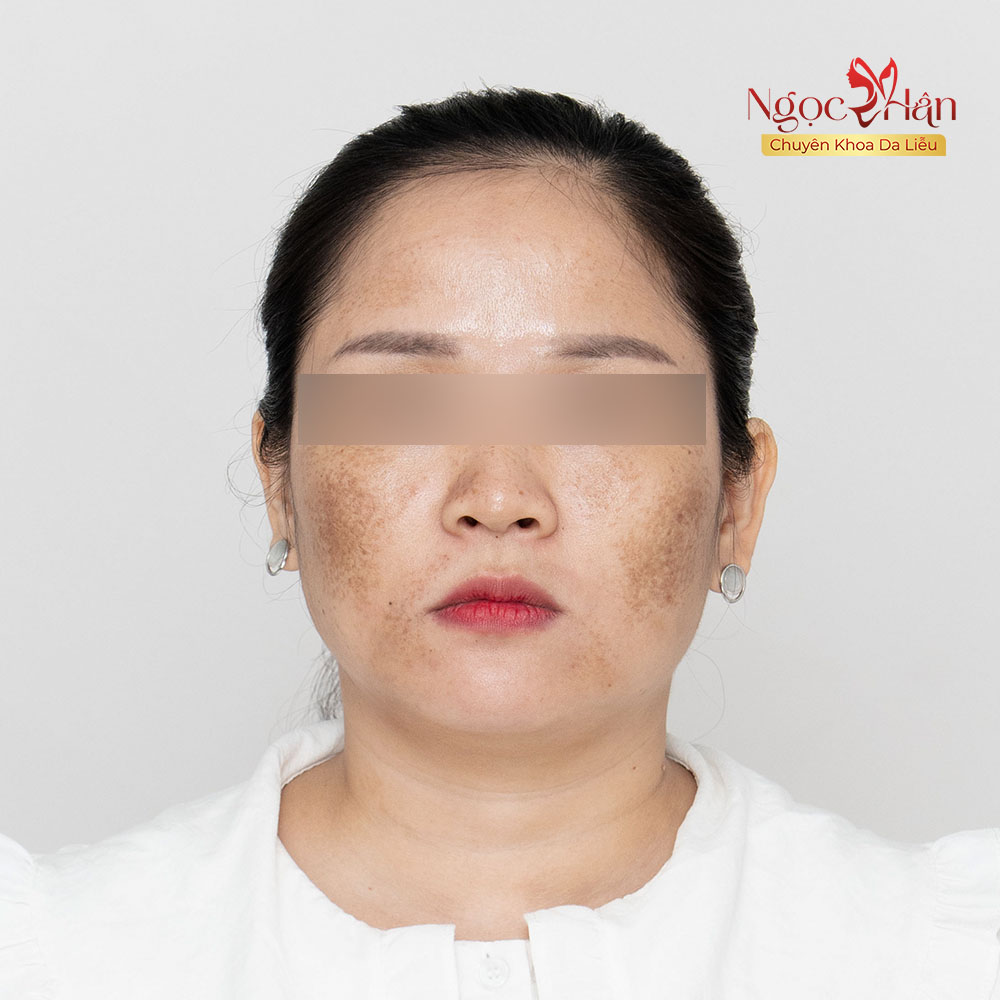 Nám Lâu Năm: Vì Sao Điều Trị Nhiều Lần Nhưng Vẫn Khó Kiểm Soát?