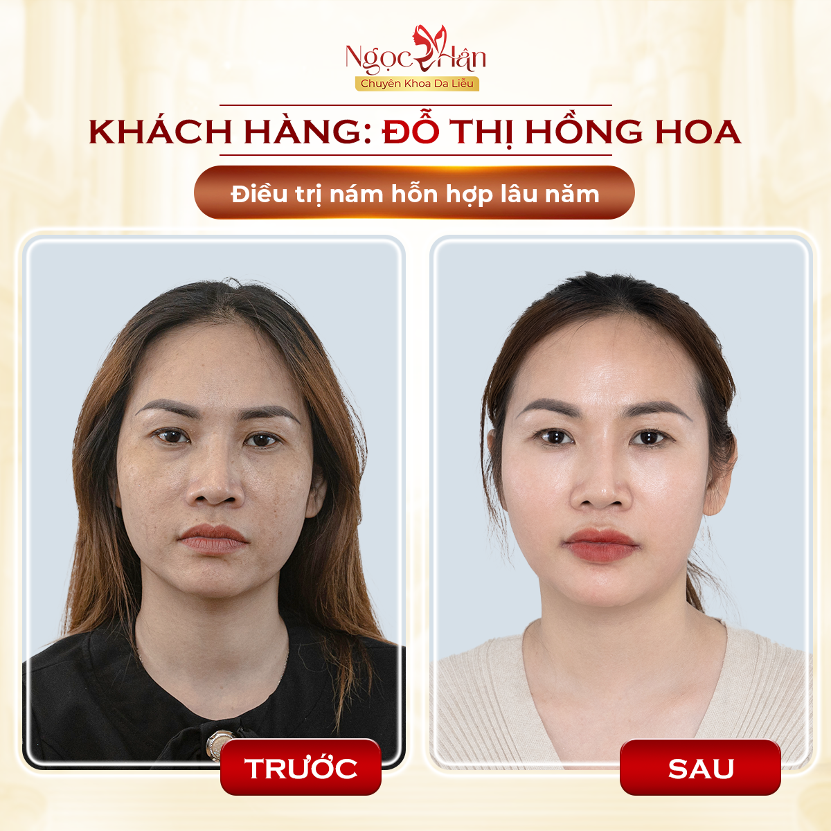 NÁM CÓ THỂ MỜ NHANH, NHƯNG KIỂM SOÁT NÁM LÂU DÀI MỚI LÀ ĐIỀU QUAN TRỌNG