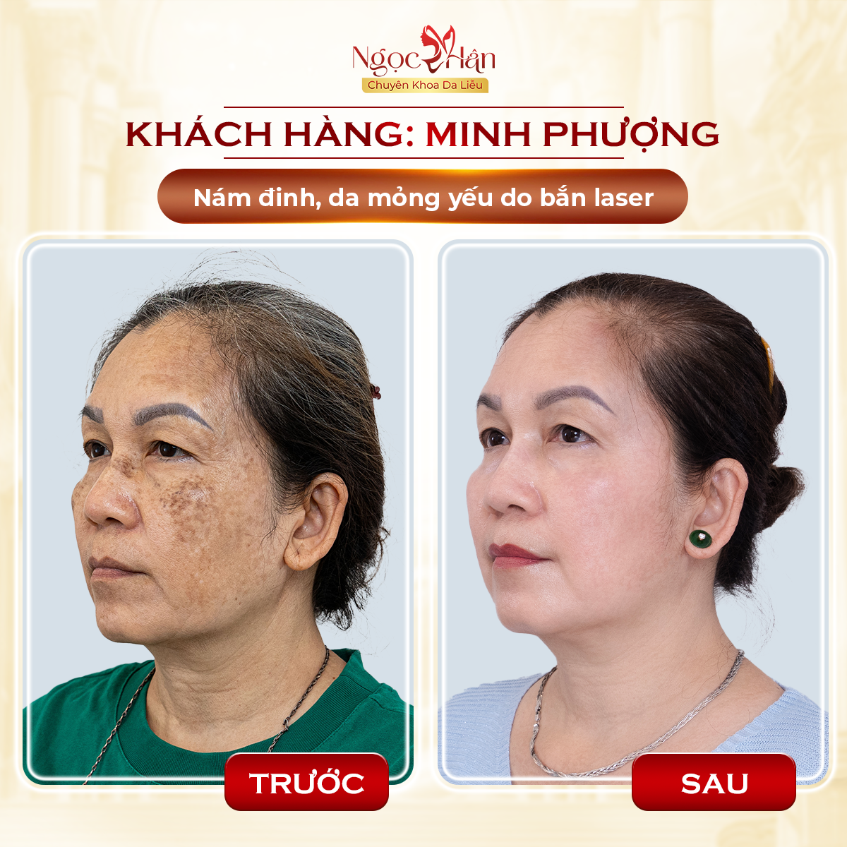 NÁM CÓ THỂ MỜ NHANH, NHƯNG KIỂM SOÁT NÁM LÂU DÀI MỚI LÀ ĐIỀU QUAN TRỌNG