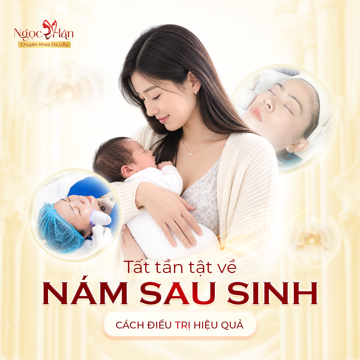 NÁM SAU SINH: NGUYÊN NHÂN, CÁCH ĐIỀU TRỊ NÁM DA SAU SINH HIỆU QUẢ